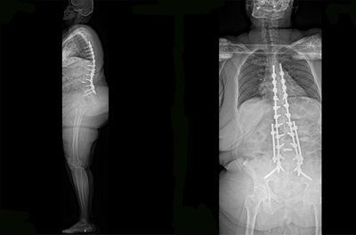 A pair of X-rays demonstrate the effects of surgery and full spinal instrumentation to straighten severe forward curvature of the spine.